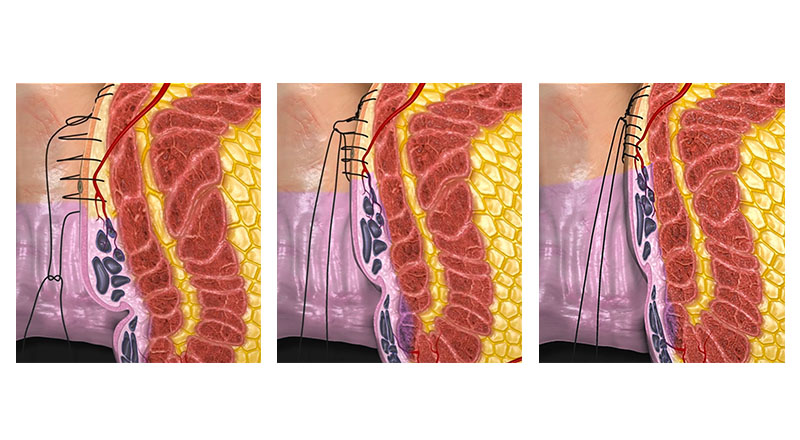 Hemorrhoid Cushion - Lindsey Medical Supply